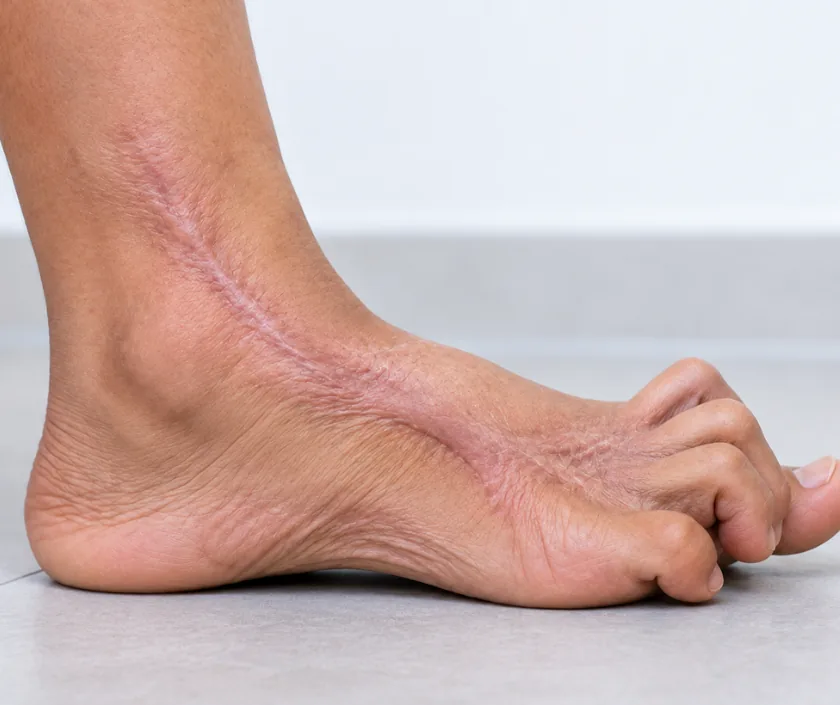 Ankle and Toe Contracture, Elegance Clinic Surat