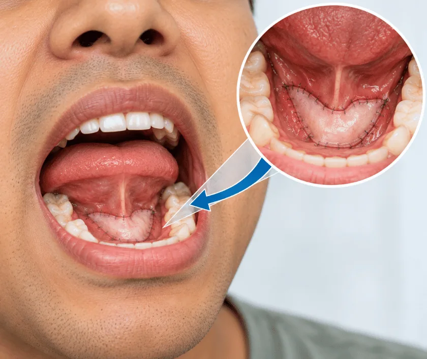 Floor of Mouth Reconstruction, Elegance Clinic Surat