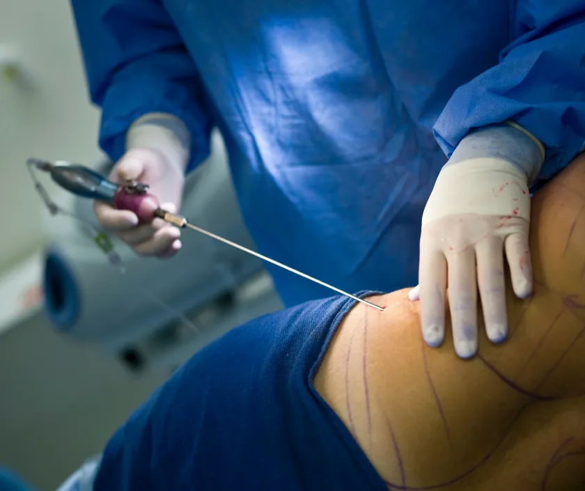 Lotus Petal Flap, Elegance Clinic Surat