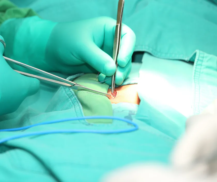 Mesh Exposure and Infected Mesh, Elegance Clinic Surat