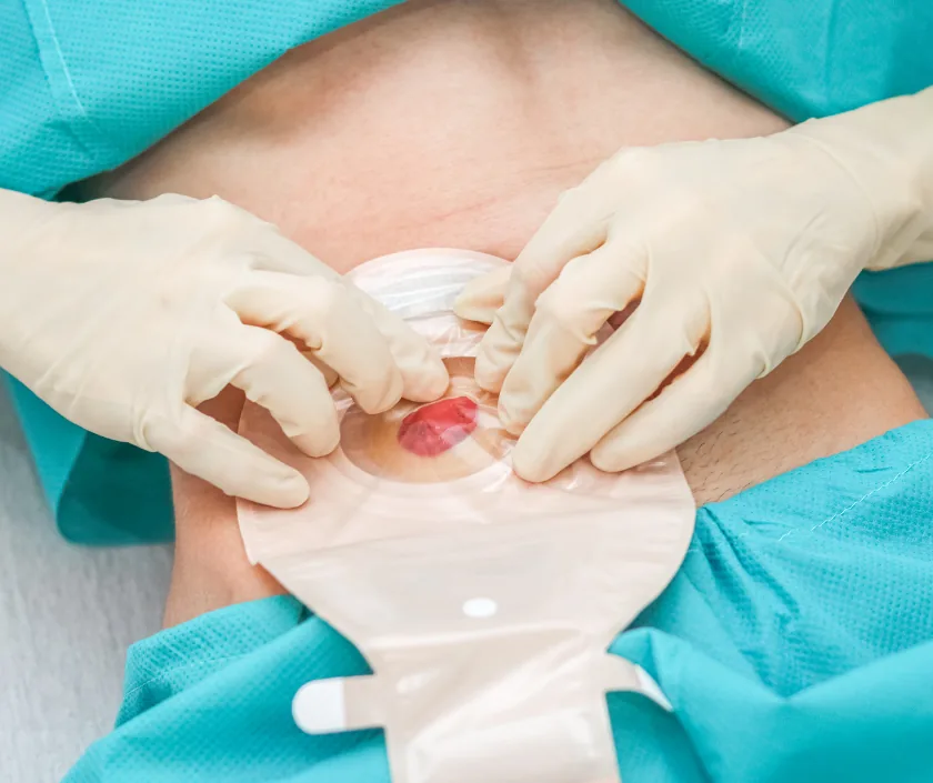 Open Abdomen Management, Elegance Clinic Surat