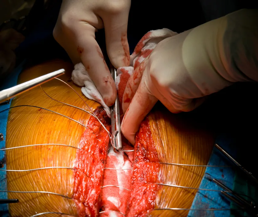 Rib and Sternal Defect Reconstruction, Elegance Clinic Surat