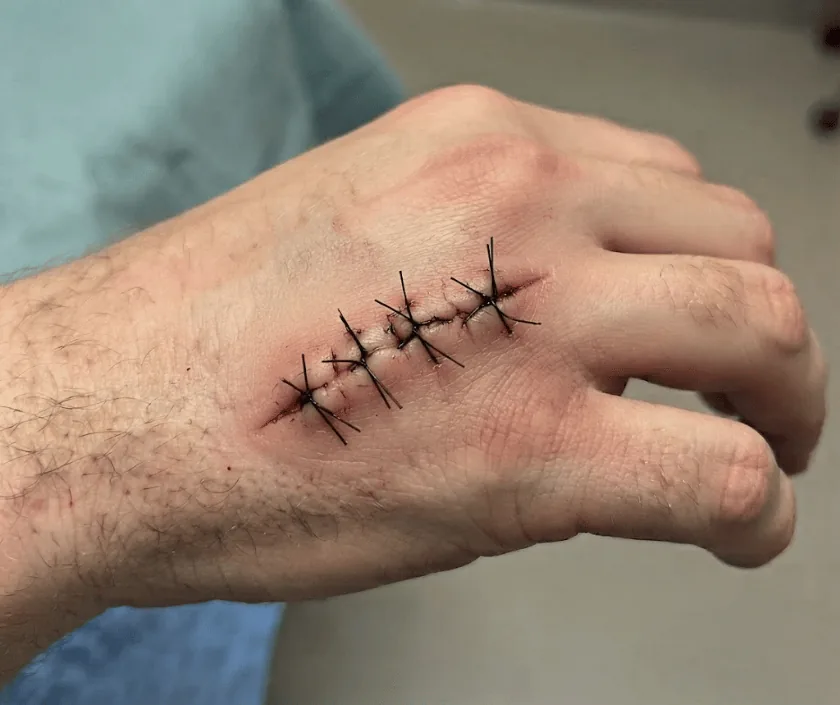 Exposed Bone Wound, Elegance Clinic Surat