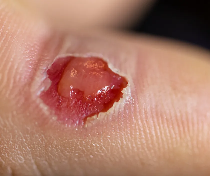 Exposed Implant Wound, Elegance Clinic Surat