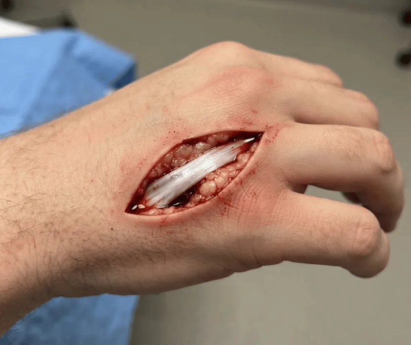 Exposed Tendon Wound, Elegance Clinic Surat