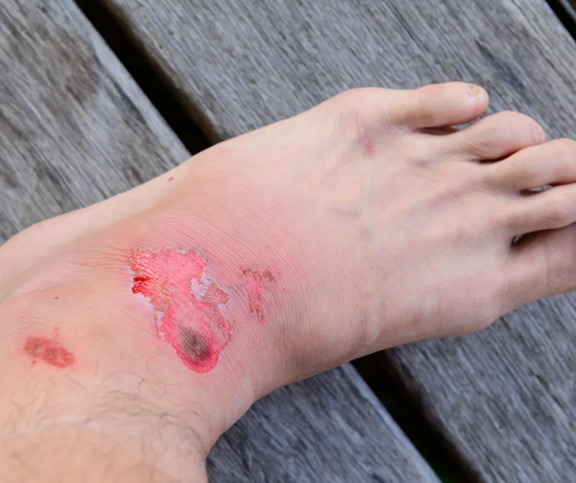 Exposed Vessel Wound, Elegance Clinic Surat