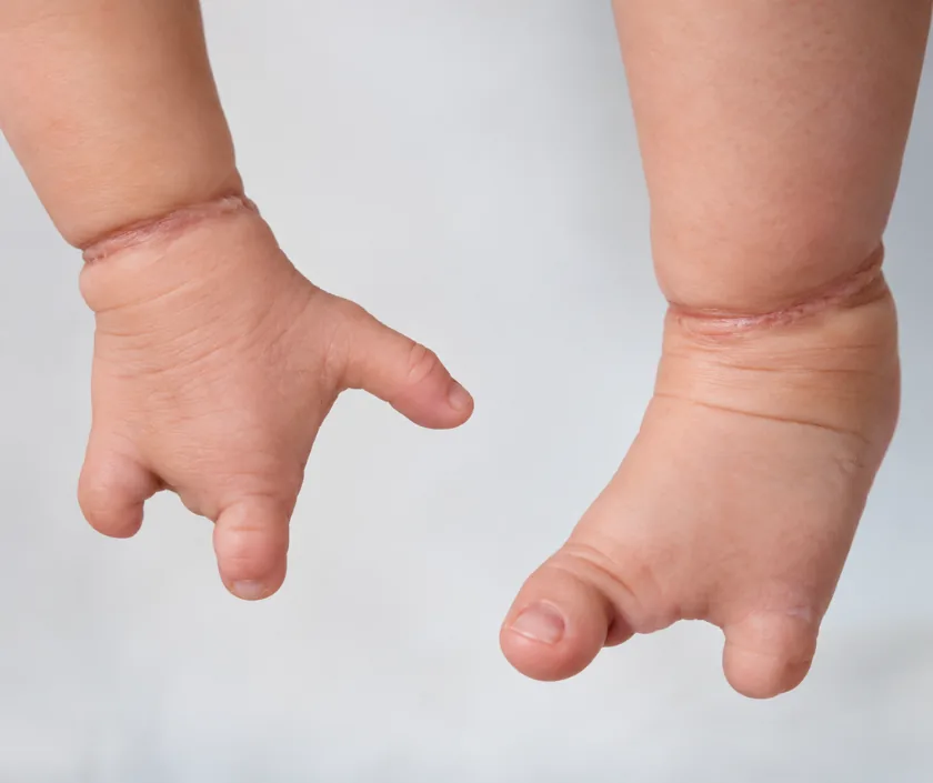Amniotic Band Syndrome, Elegance Clinic Surat