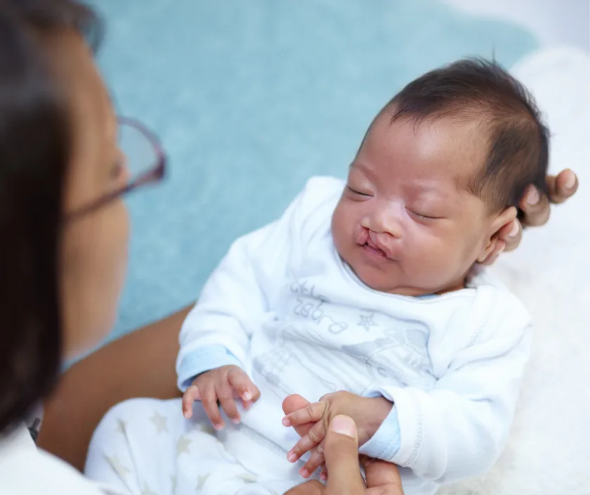 Bilateral Cleft Lip Repair, Elegance Clinic Surat