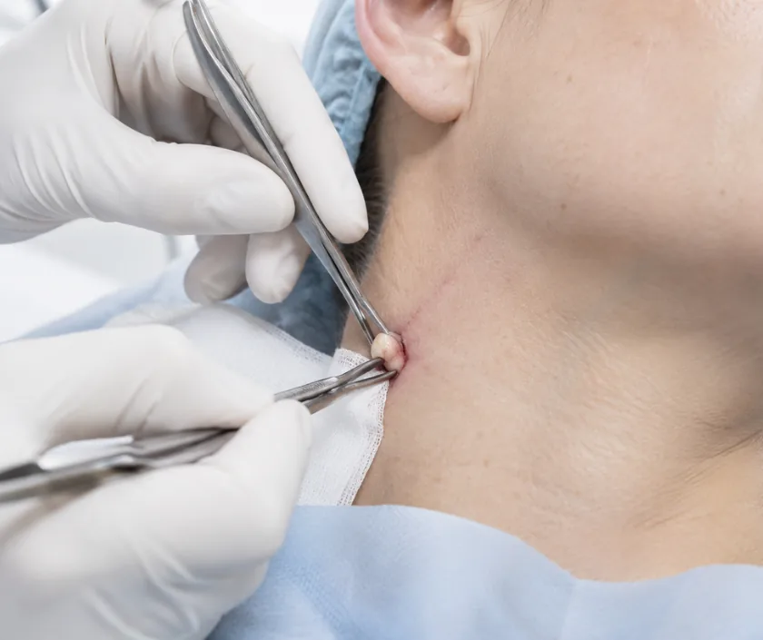 Neck Lesions, Elegance Clinic Surat