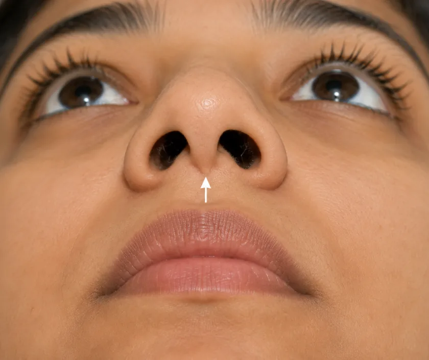 Columellar Notching, Elegance Clinic Surat