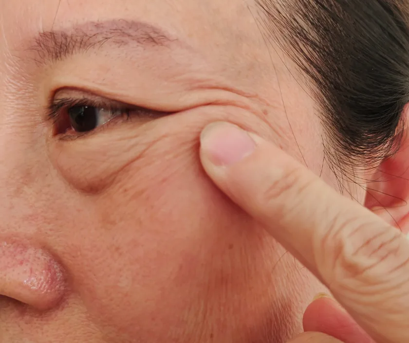 Eyelid and Orbit, Elegance Clinic Surat