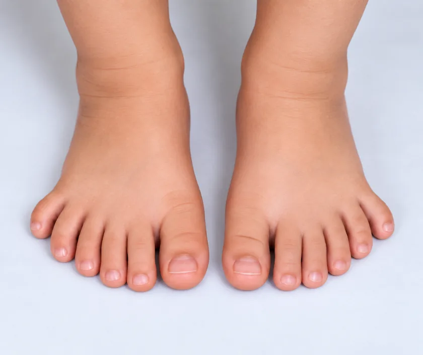 Foot Polydactyly, Elegance Clinic Surat