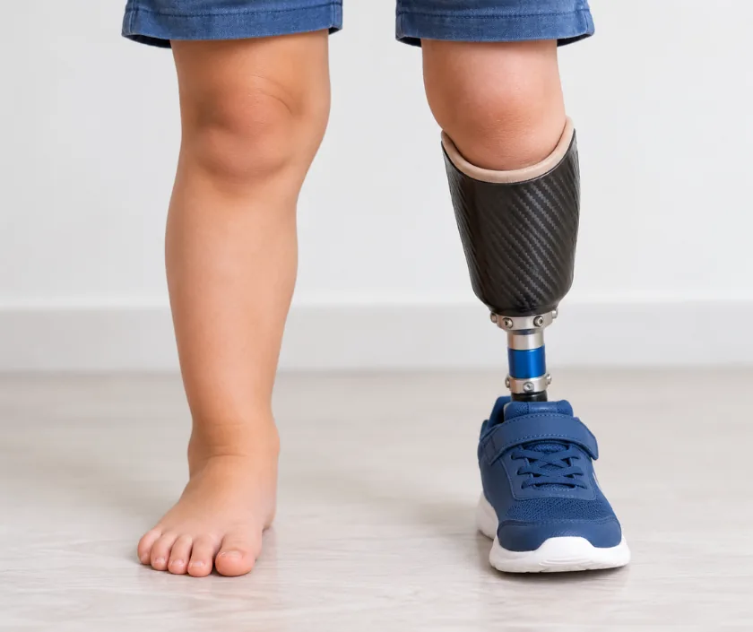 Limb Deficiency Reconstruction, Elegance Clinic Surat