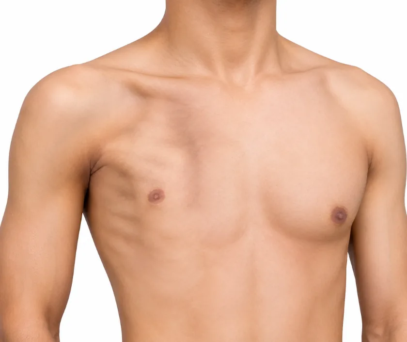 Poland Syndrome Reconstruction, Elegance Clinic Surat