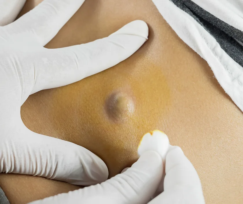 Thyroglossal Cyst Surgery, Elegance Clinic Surat