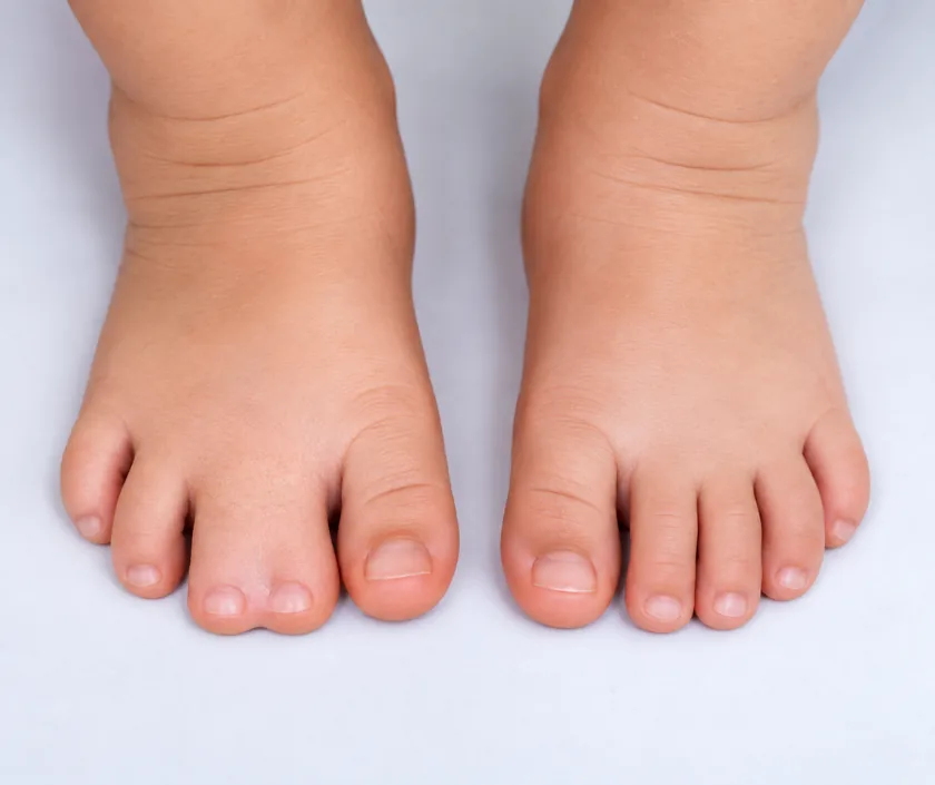 Toe Syndactyly, Elegance Clinic Surat