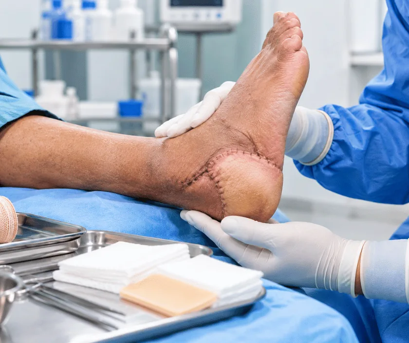 Heel Ulcer Reconstruction, Elegance Clinic Surat