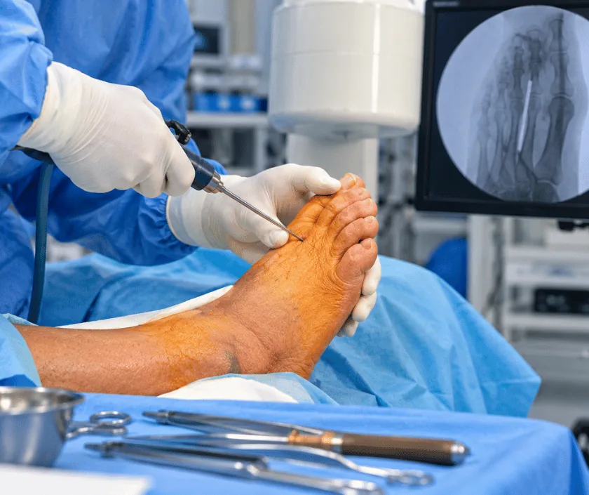 Internal Offloading Surgery, Elegance Clinic Surat