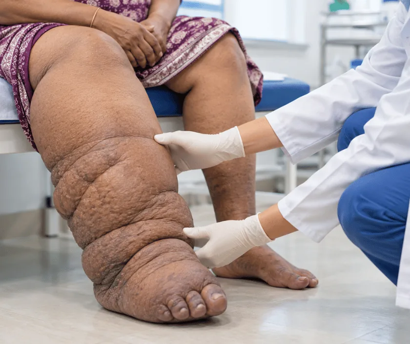 Filariasis & Elephantiasis Reconstruction, Elegance Clinic Surat
