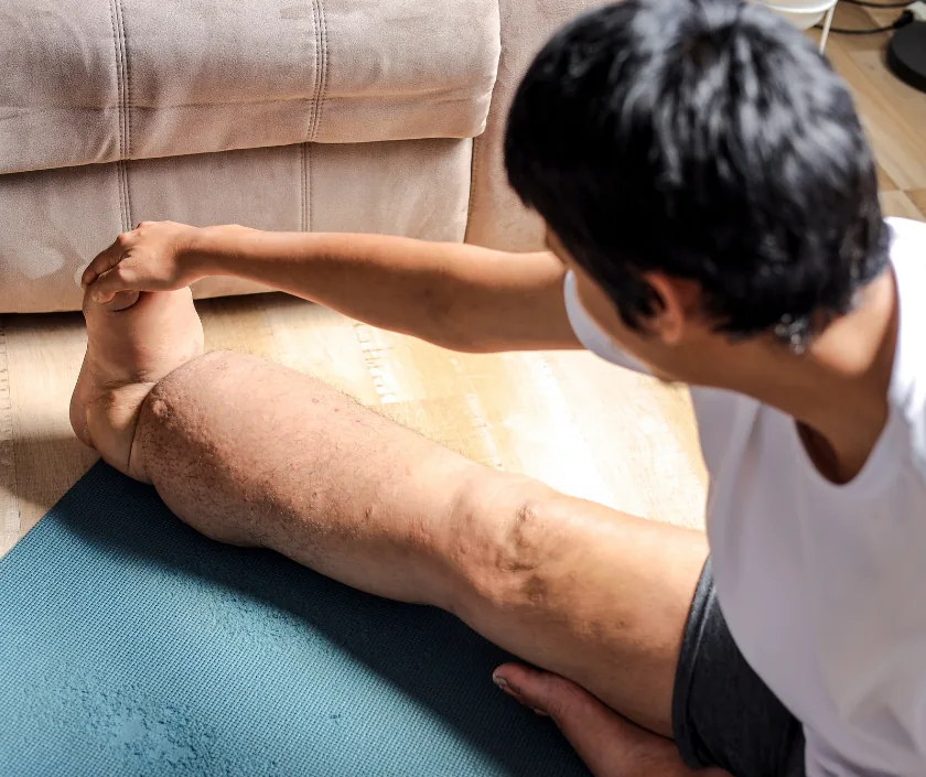 Scrotal Lymphedema Surgery, Elegance Clinic Surat