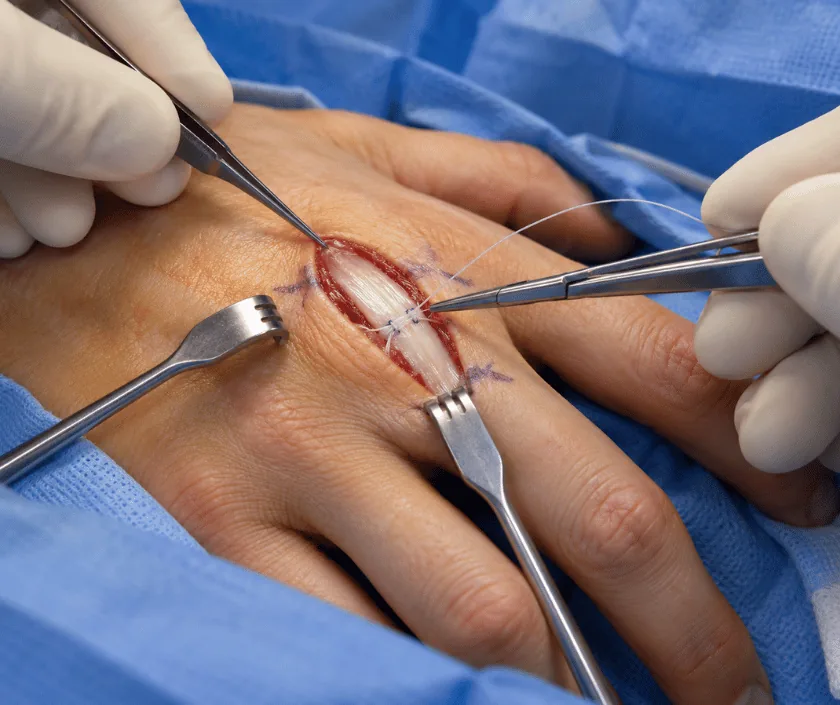 Extensor Tendon Repair, Elegance Clinic Surat