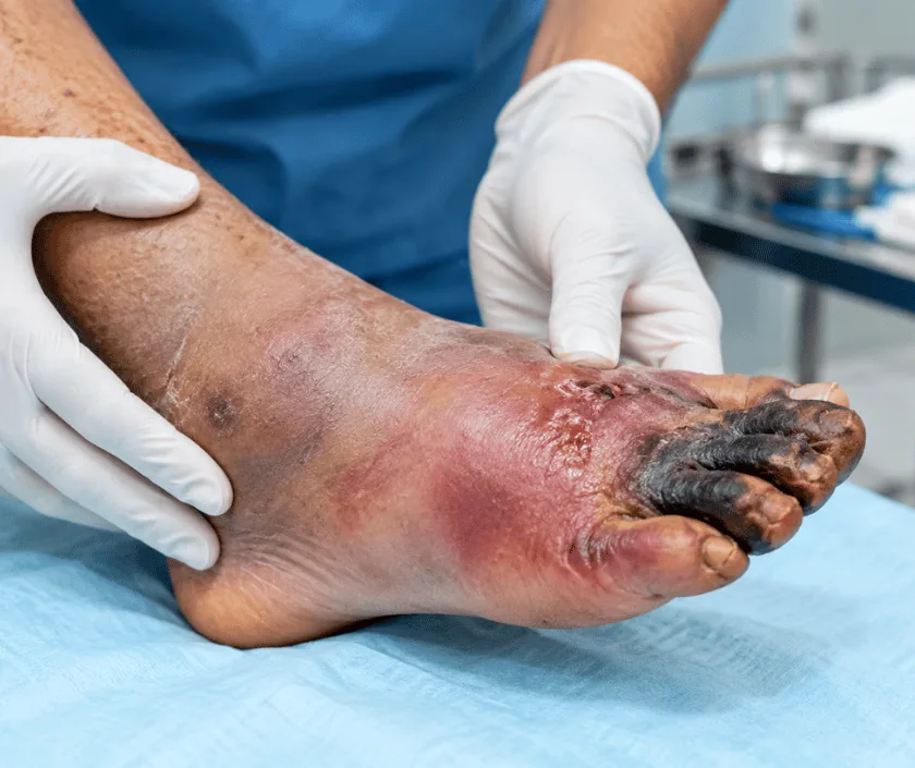 Cellulitis and Abscess Management, Elegance Clinic Surat