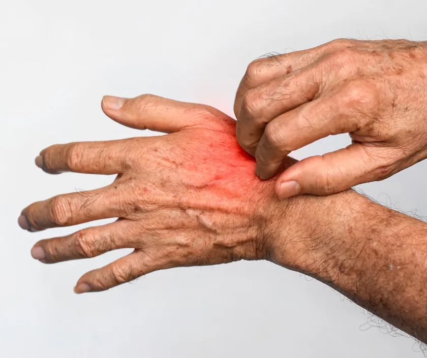Chronic Fungal Soft Tissue Infection, Elegance Clinic Surat