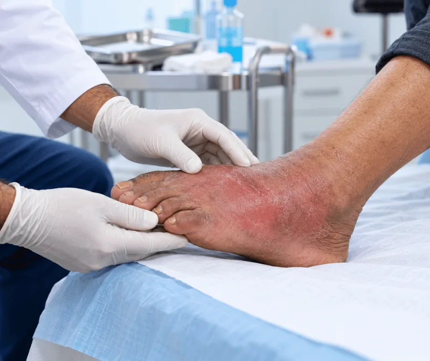 Diabetic Soft Tissue Infection, Elegance Clinic Surat