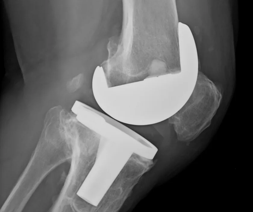 Infected Prosthesis Coverage, Elegance Clinic Surat