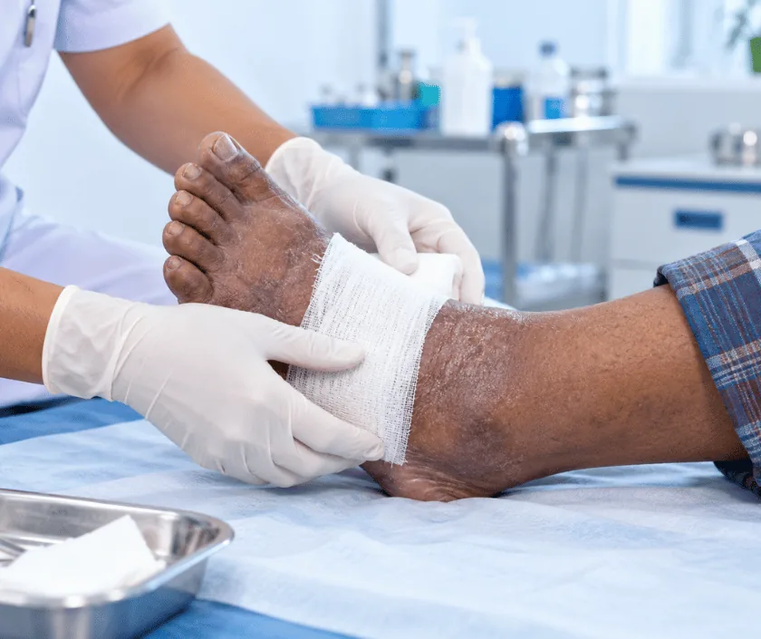 Madura Foot Mycetoma Treatment, Elegance Clinic Surat