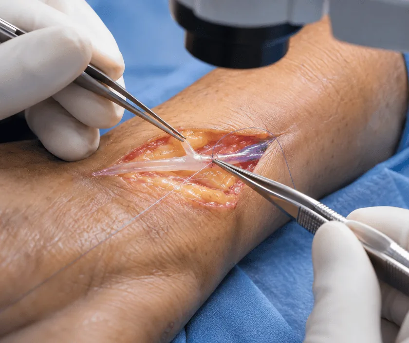 Lymphovenous Anastomosis LVA, Elegance Clinic Surat