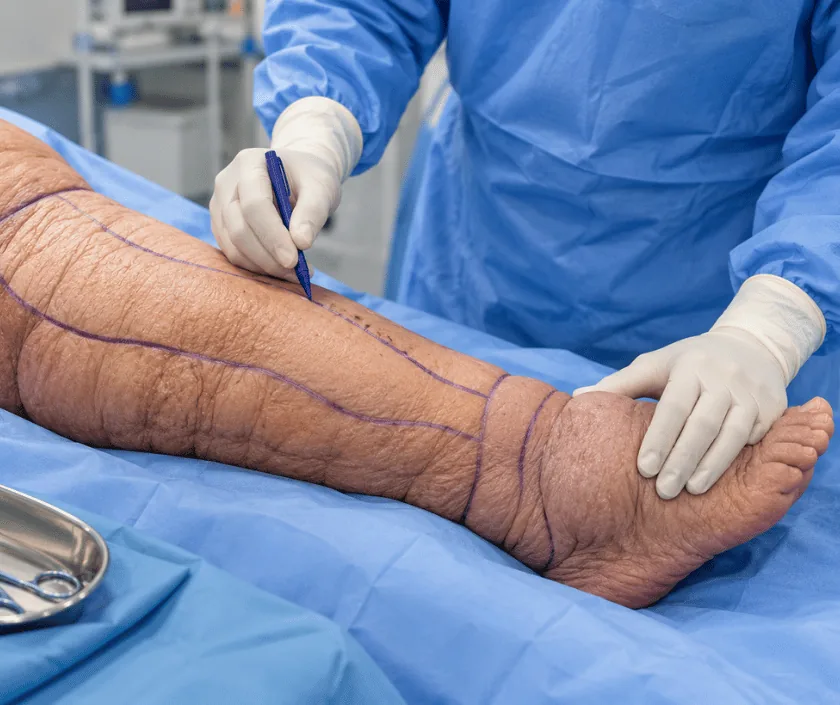 Nodovenous Shunt, Elegance Clinic Surat