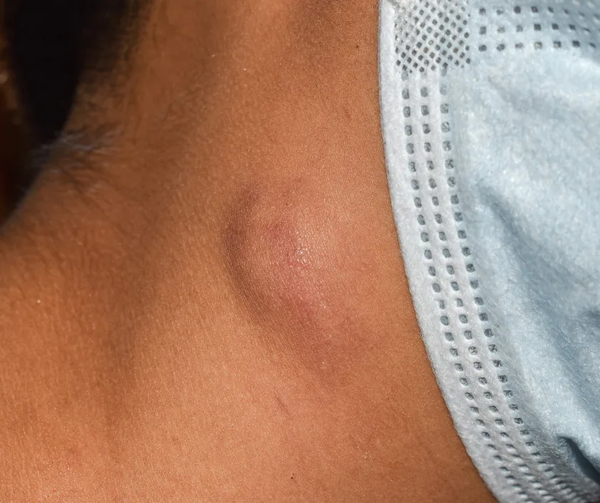 Vascularized Lymph Node Transfer VLNT, Elegance Clinic Surat
