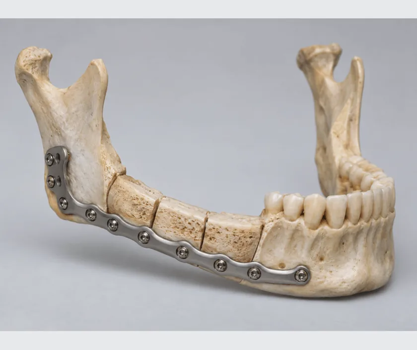 Free Fibula Flap for Jaw Reconstruction, Elegance Clinic Surat
