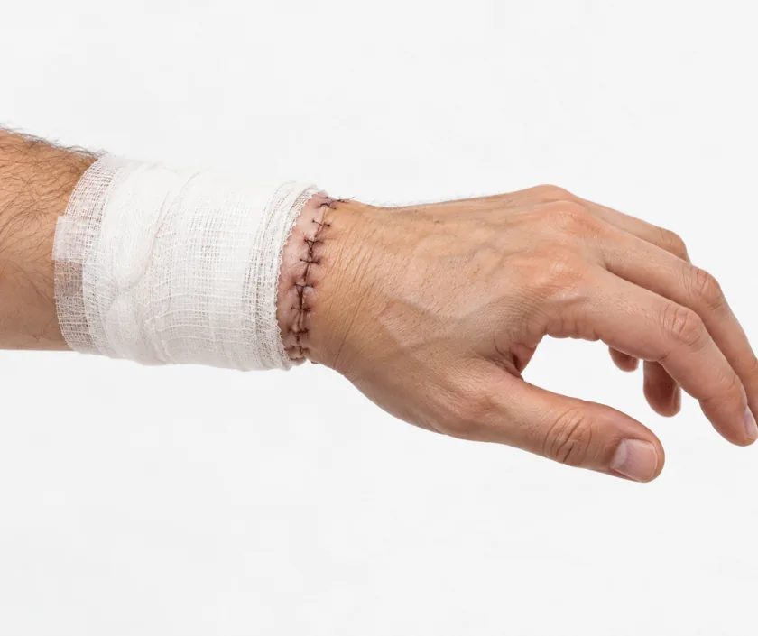 Hand Replantation, Elegance Clinic Surat