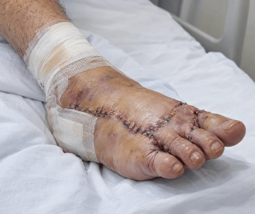 Toe and Foot Replantation, Elegance Clinic Surat