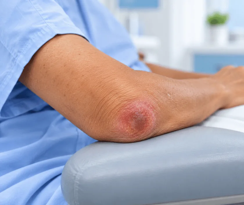 Elbow Pressure Sore, Elegance Clinic Surat