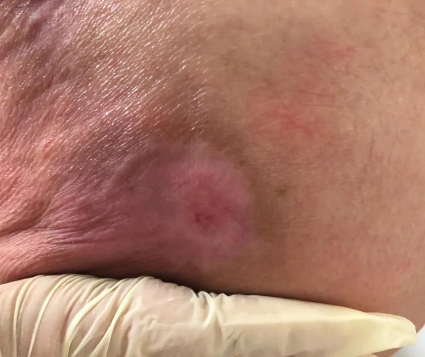 Flap Surgery for Bedsores, Elegance Clinic Surat