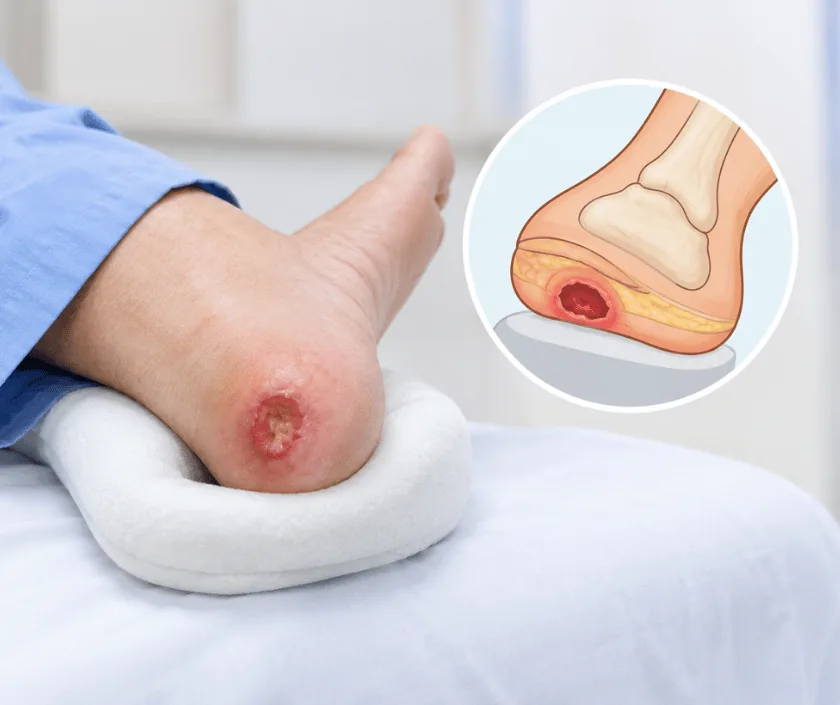 Heel Pressure Sore, Elegance Clinic Surat