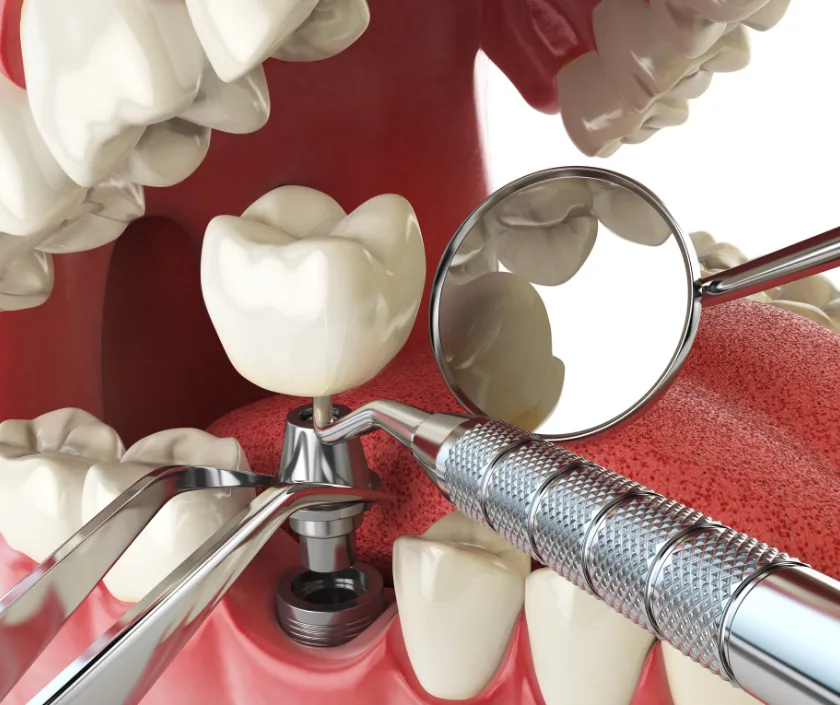 Implant Salvage Surgery, Elegance Clinic Surat