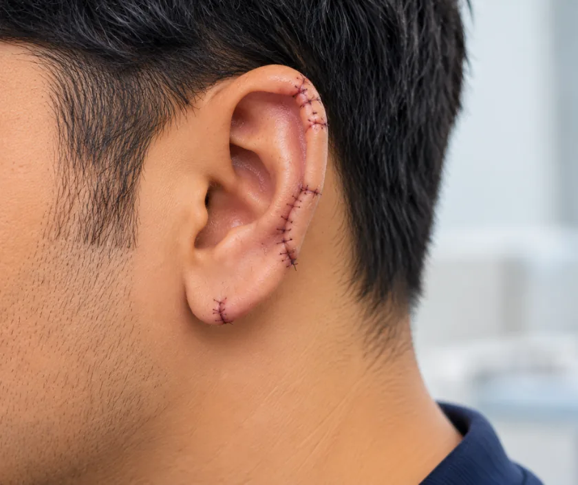 Ear Avulsion Repair, Elegance Clinic Surat